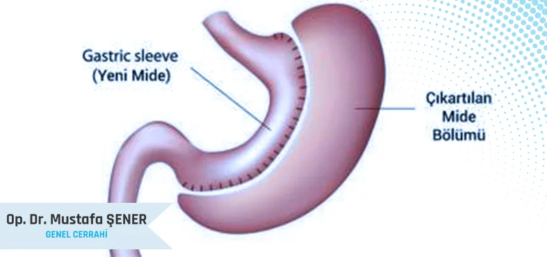 Tüp Mide Ameliyatı (Sleeve Gastrektomi)