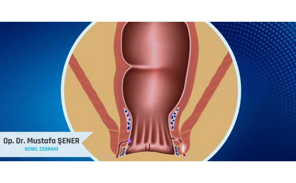 hemoroid tedavisi